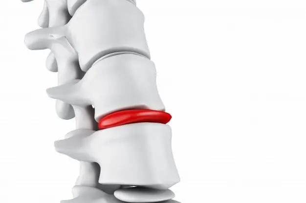 ernia del disco - dr. Carollo