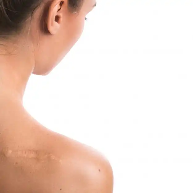 Woman With Scar Her Shoulder 144962 7265