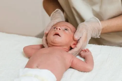 Plagiocefalia posizionale